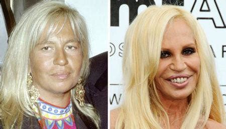 donatella versace avant chirurgie